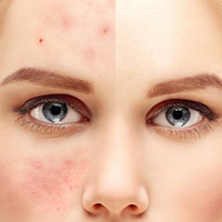 #BeautyGlossary: What is rosacea?